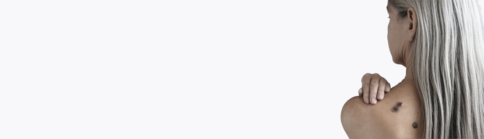 Старческая (сенильная) кератома