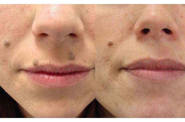 Удаление родинок лазером – стоимость в Санкт-Петербурге | Альтермед Эстетик