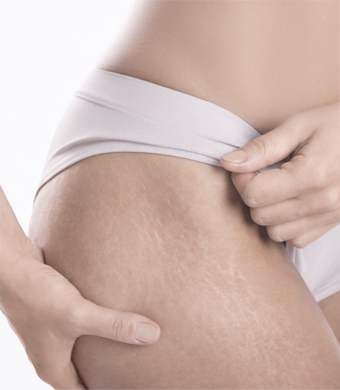 Растяжки на коже