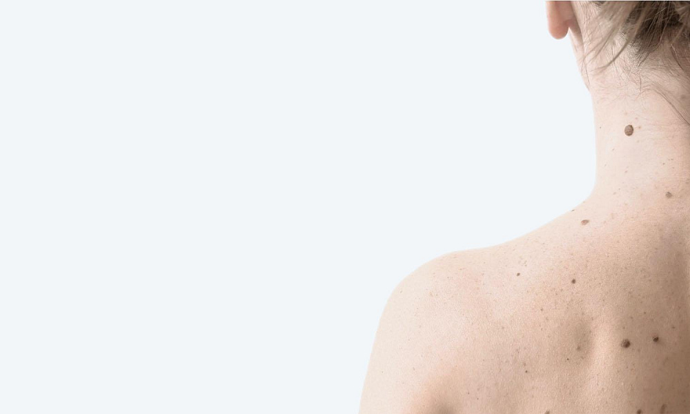 Удаление новообразований в СПб | Лазерное удаление новообразований кожи ...